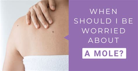When Should I Worry About A Mole Epsom Skin Clinic