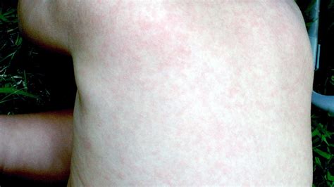 Real Life Experience Child Rash On Body No Fever