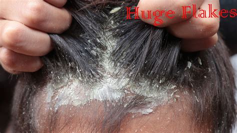 Huge Flakes Dandruff Scratching Itchy Dry Scalp Scratching Scalp On