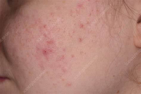Acne Stock Image C0564380 Science Photo Library