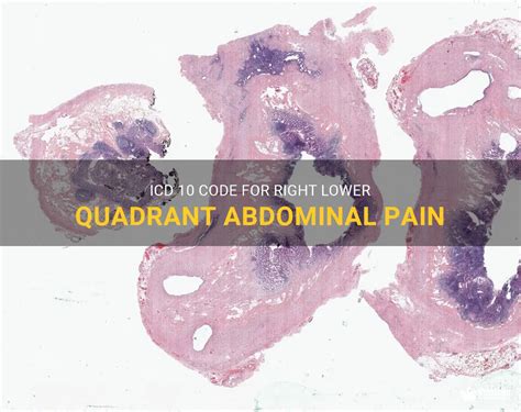 Icd 10 Code For Right Lower Quadrant Abdominal Pain Medshun