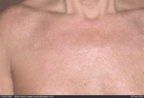 Stock Image Dermatology Pityriasis Versicolor Multiple Irregular