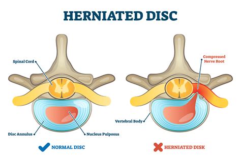 Herniated Disc Injury As Labeled Spinal Pain Explanation Vector The