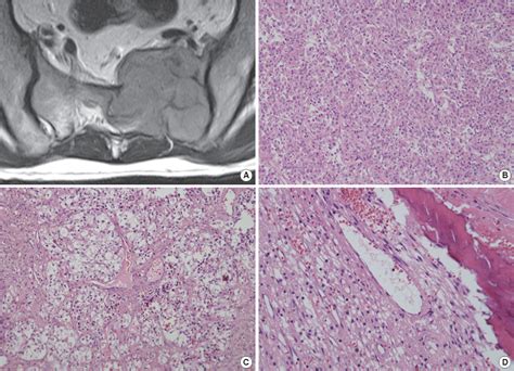 Figure 1 From Perivascular Epithelioid Cell Tumor Arising In The Sacrum