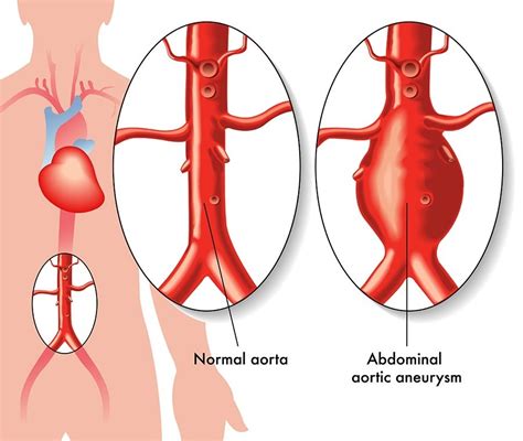 How Aortic Aneurysms Are Treated Aortic Aneurysm My Xxx Hot Girl