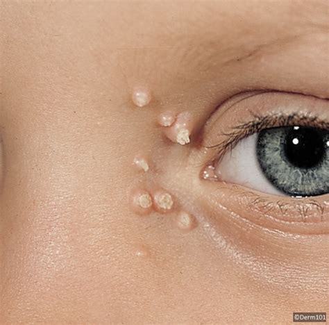 Molluscum Contagiosum — Ophthalmology Review