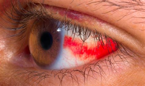 High Blood Pressure Symptoms Blood Spots In The Eyes Could Indicate