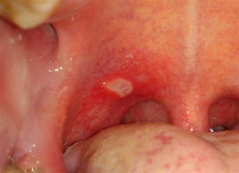 treatment for roof of mouth sore