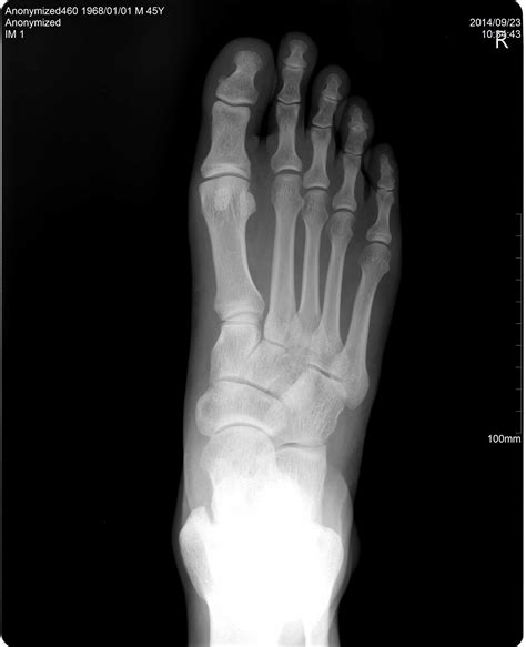 Normal Foot X Ray Normal Foot Series Image