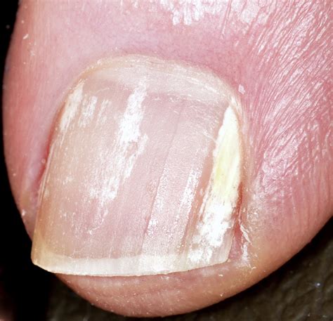 Fungal Nail Infections Journal Of Hand Surgery