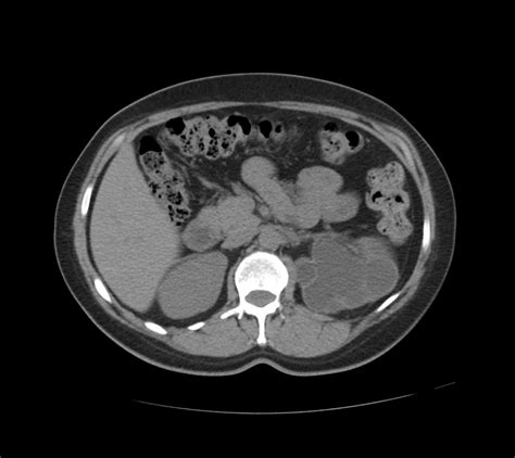 Hydronephrosis Ct Wikidoc