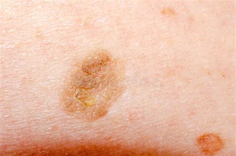 Nevus Or Papilloma Or Mole Or Melanoma Or Keratosis On The Skin Of An