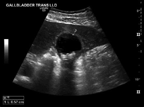 Gallbladder Wall Measurement Ultrasound