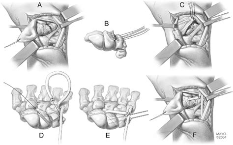 Ulnar Sided Wrist Pain Diagnosis And Treatment Semantic Scholar