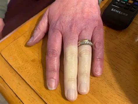 woman s fingers turn white due to rare condition viral hand woman s fingers turn completely