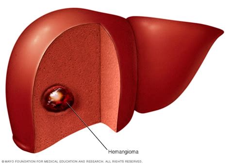Liver Hemangioma Mayo Clinic