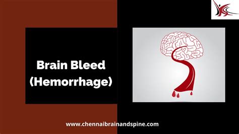 Brain Bleed Hemorrhage Symptoms Causes And Its Treatment Youtube