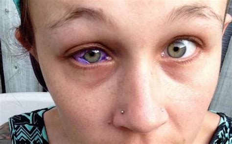 Model Shedding Purple Tears At Risk Of Losing Eye After Scleral Tattoo