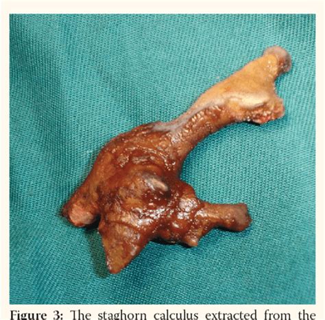 Pdf Staghorn Calculus In A Horseshoe Kidney Semantic Scholar