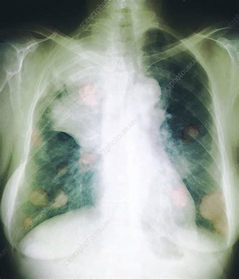 Primary lung tumors can spread to other areas of the lungs, lymph nodes, bones, and the brain, although spread to other organs. Secondary lung cancer, X-ray - Stock Image - C015/2693 ...
