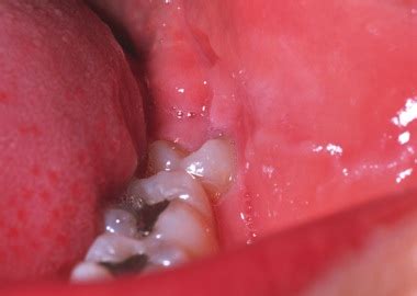 It takes time and proper care for the mouth tissue to heal correctly. How Long Do Wisdom Teeth Holes Take To Heal - A Pictures ...
