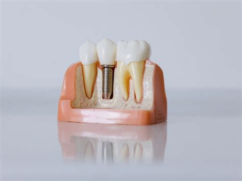 All You Need To Know About Dental Implants