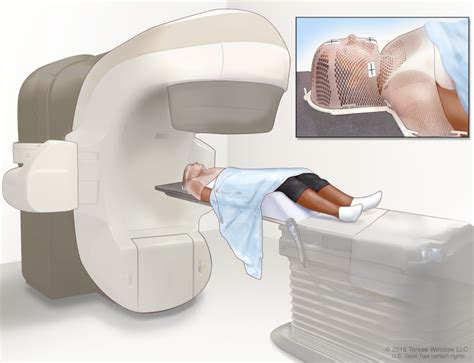 Figure External Beam Radiation Therapy Of The Pdq Cancer