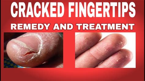 Cracked Fingertips Remedy How To Heal Cracked Fingertipsskin Care