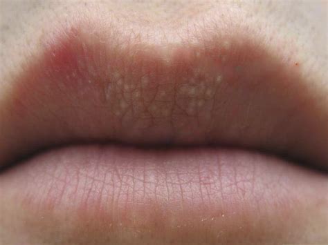 Fordyce Spots On Lips Treatment All You Need Infos Kulturaupice