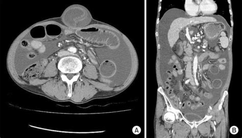 Contrast Enhanced Abdominal Computed Tomography Scans O Open I