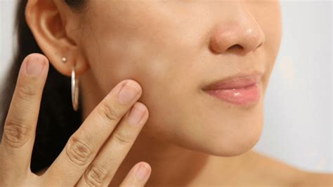 How To Get Rid Of White Spots On The Skin Health Synonyms