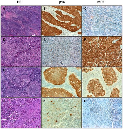 Imp3 And P16 Expression In Squamous Cell Carcinoma Of The Head And Neck