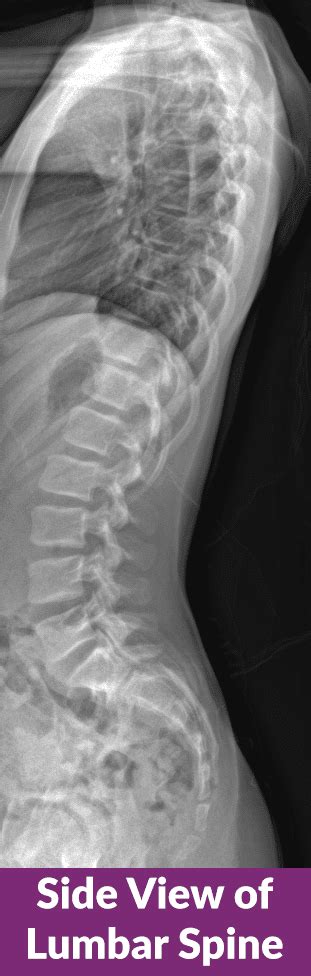 Mri Scan Sagittal View Lumbosacral Spine Has Straight