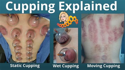 Three Cupping Therapy Techniques Explained And Demonstrated Youtube