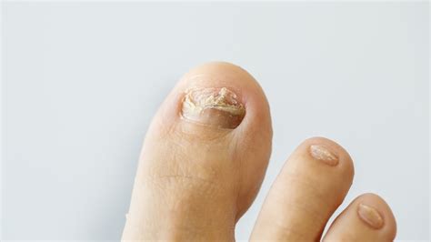 I have ugly toe nail fungus since almost 3 years now. Nail fungus doctor near me, MISHKANET.COM