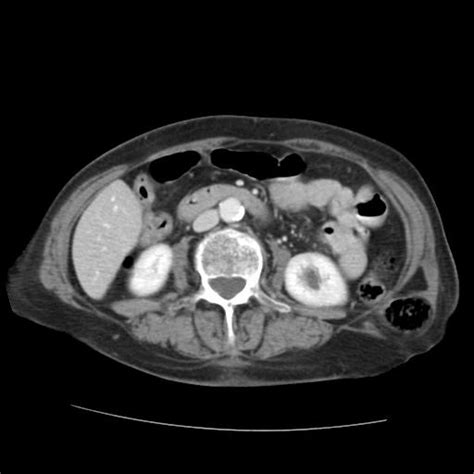 Petits Lumbar Triangle Hernia Ct Findings Eurorad