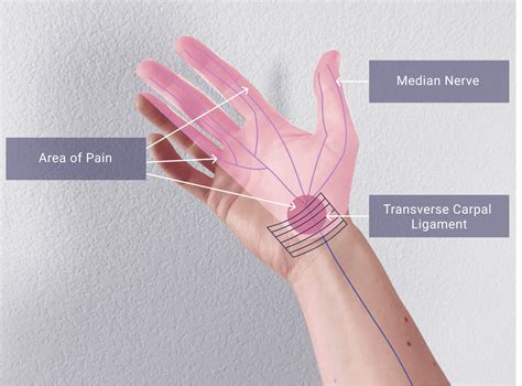 Whats Causing Carpal Tunnel Syndrome And How To Prevent It Blog