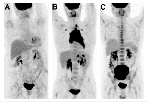 Diffuse Bone Marrow Uptake Pattern In F Fdg Pet Ct A And B Download Scientific Diagram