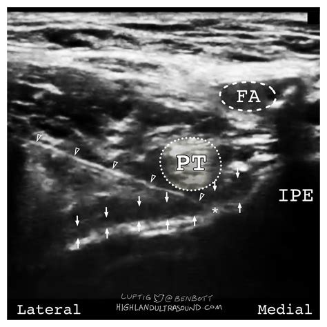 Peng — Highland Em Ultrasound Fueled Pain Management