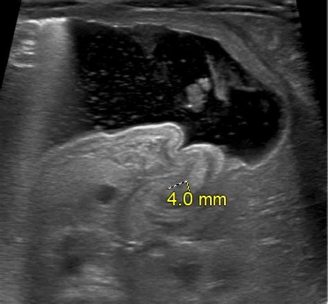 Cureus Hypertrophic Pyloric Stenosis In Dizygotic Twins Case Report