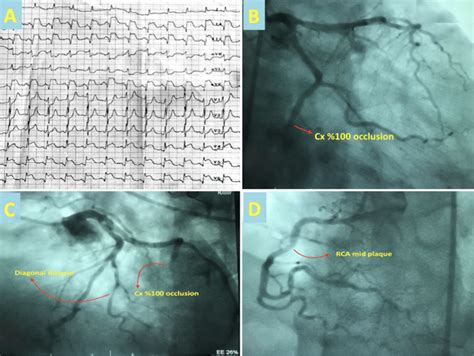 A Electrocardiography Demonstrating Acute Inferolateral Myocardial
