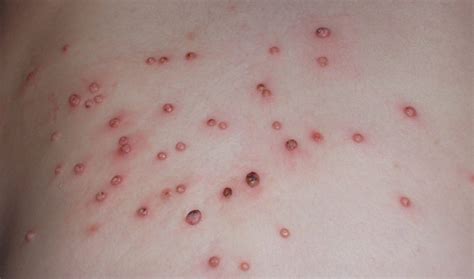 Molluscum Contagiosum In Children Things Parenting