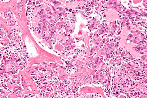 Filemedullary Thyroid Carcinoma 2 High Mag Wikimedia Commons