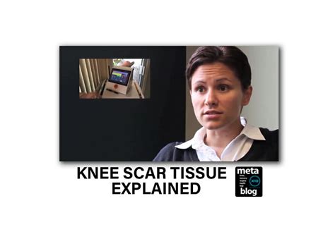 Knee Scar Tissue Solutions Physical Therapy And The X10