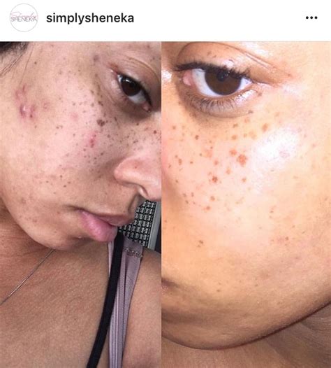 Sheneka Adams Says Semen Facials Keep Her Skin Clear Bossip