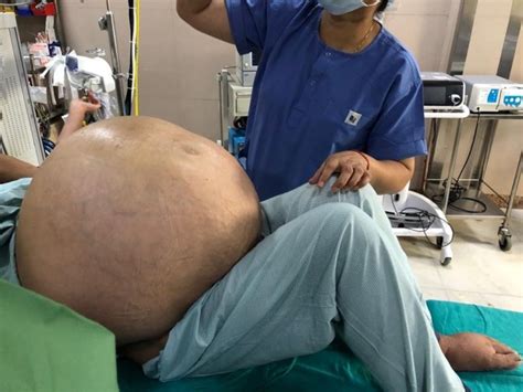 Doctors In India Remove Worlds Largest Ovarian Tumour From Woman