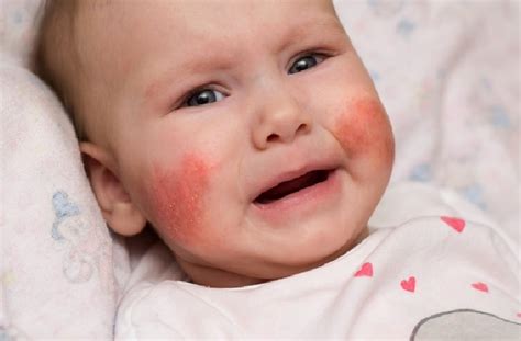 Pityriasis rosea dan bintik merah pada kulit. Mengenal Penyakit Eksim yang Sering Terjadi pada Bayi ...