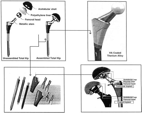 Evolution Of Hip Implant Designs Download Scientific Diagram