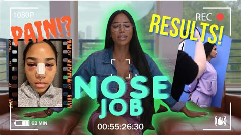 nose job full experience 😱 do i regret it 😳🫢 virginia sanhouse youtube