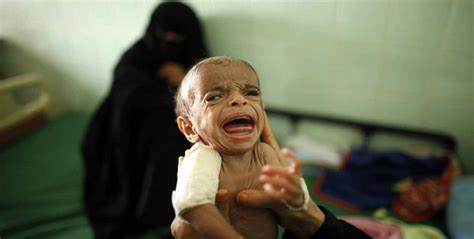 Agresión saudí en Yemen es culpable de la muerte de niños por desnutrición Mundo